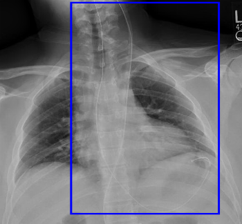 Nasogastric Tube