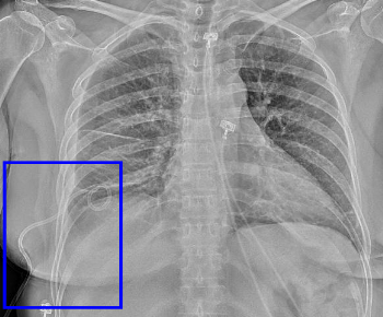 Pigtail Thoracostomy Catheter