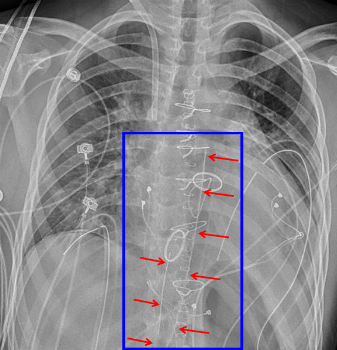 Mediastinal Drain