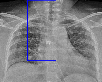 Central Venous Catheter