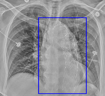 Aortic Stent Graft