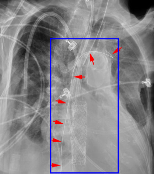 LinesTubes.com - Lines, Tubes, and Devices in the Upper Mediastinum