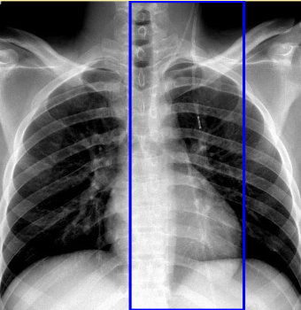 Ventriculoperitoneal Shunt