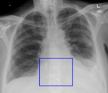 Dual Leadless Pacemaker