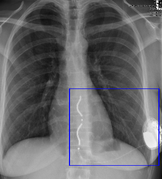 Extravascular Defibrillator